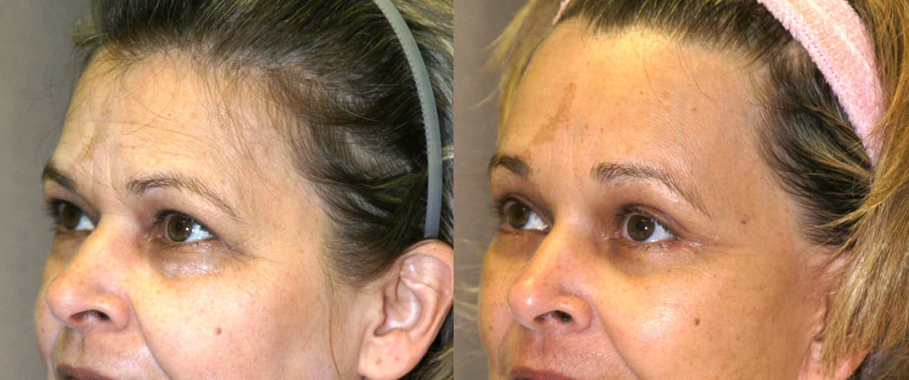 Brow lift before and after photographs, case 1, with the before photograph on the left and the after photograph on the right