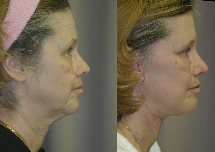Facelift before and after photographs, case 9, with the before photograph on the left and the after photograph on the right