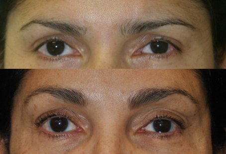 Brow lift before and after photographs, case 5, with the before photograph on top and the after photograph below