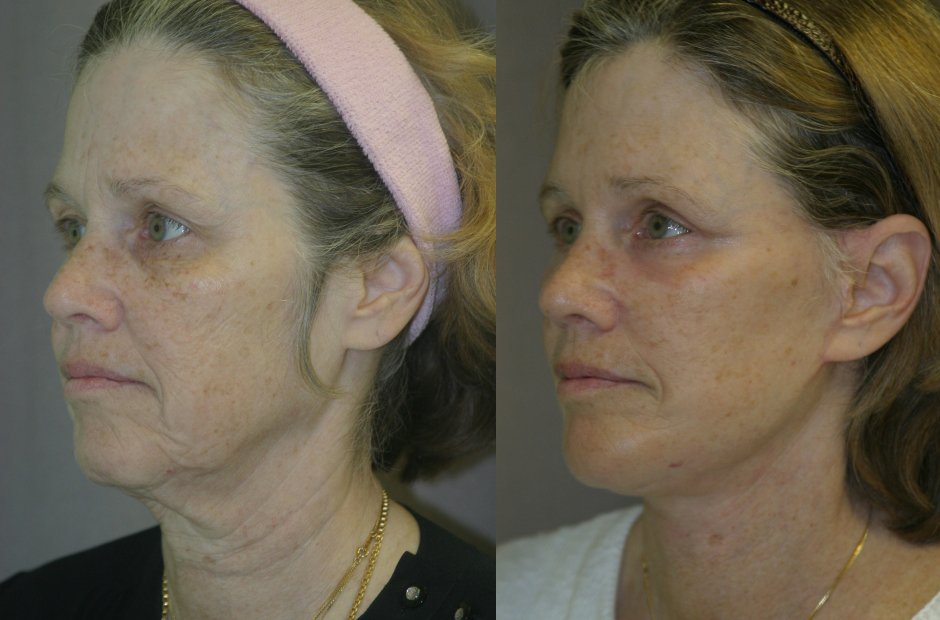 Facelift before and after photographs, case 8, with the before photograph on the left and the after photograph on the right
