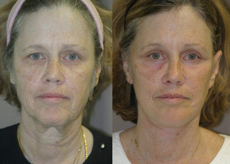 Facelift before and after photographs, case 7, with the before photograph on the left and the after photograph on the right