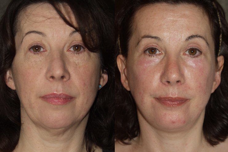 Facelift before and after photographs, case 10, with the before photograph on the left and the after photograph on the right