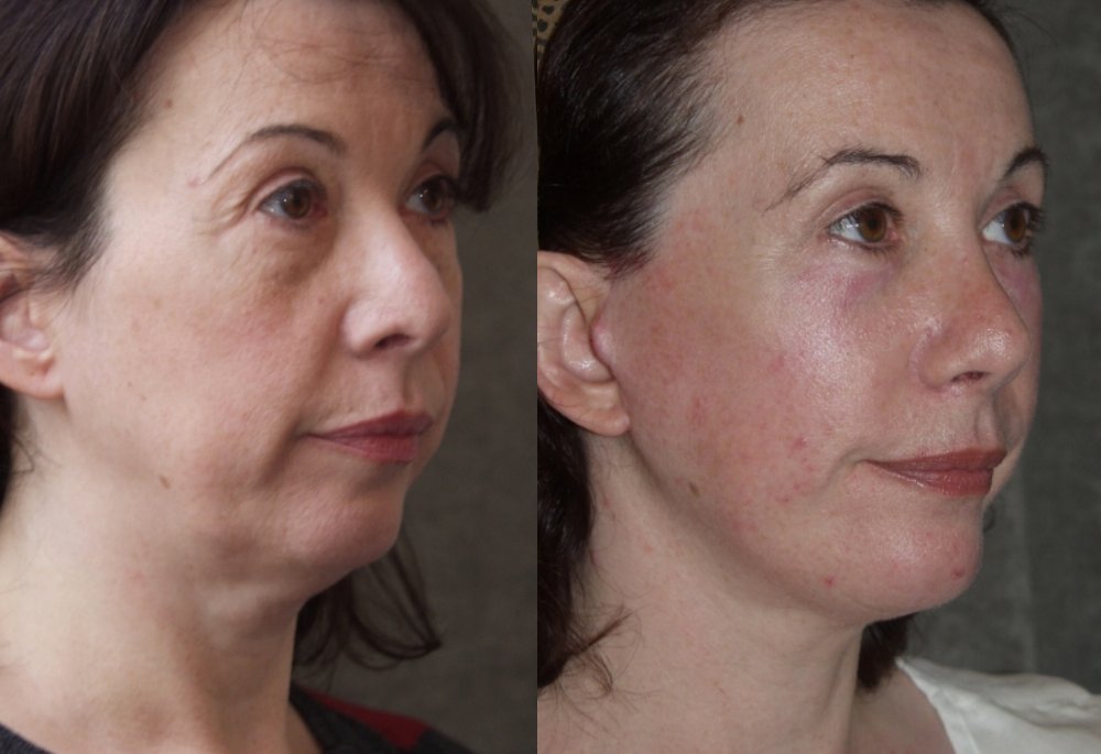 Facelift before and after photographs, case 11, with the before photograph on the left and the after photograph on the right