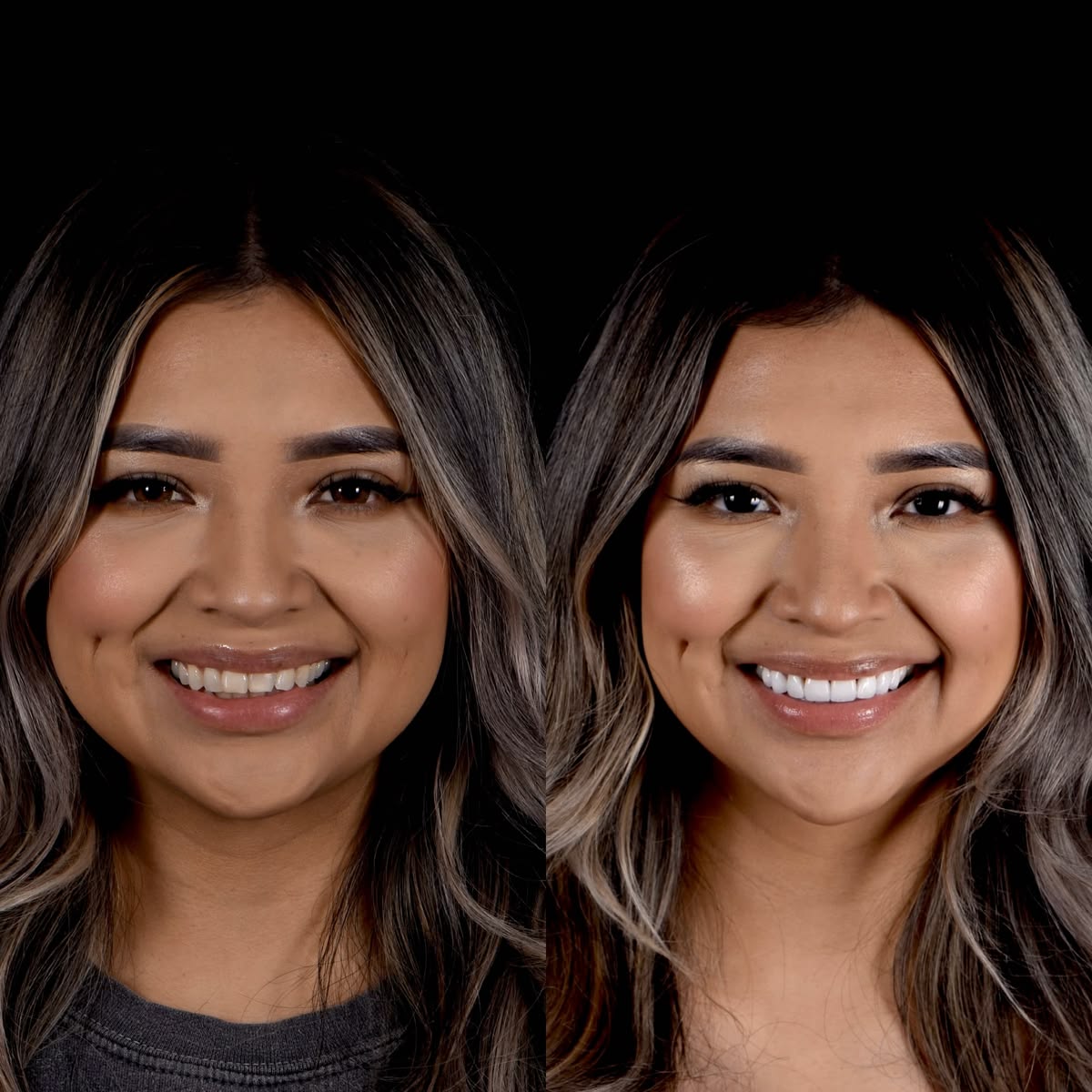Before and after smile transformation portrait