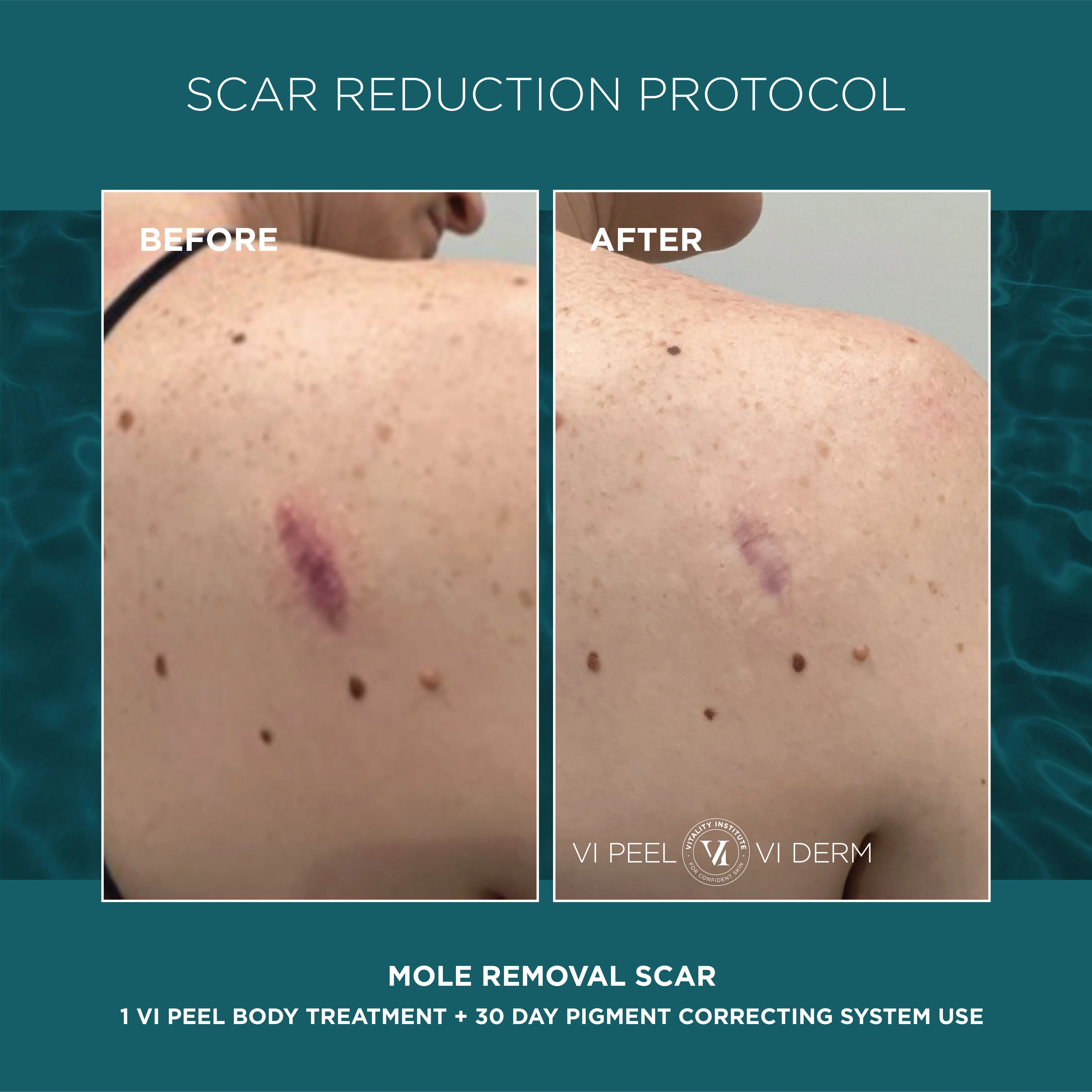 Mole Removal Scar — 1 VI Peel Body + 30 Day Pigment Correcting System