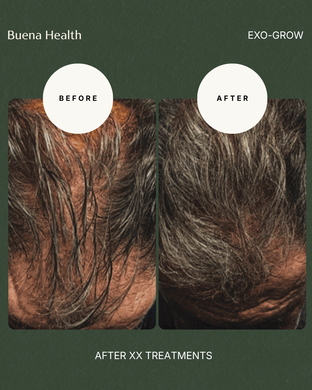 ExO-Grow scalp treatment before and after result showing fuller crown coverage