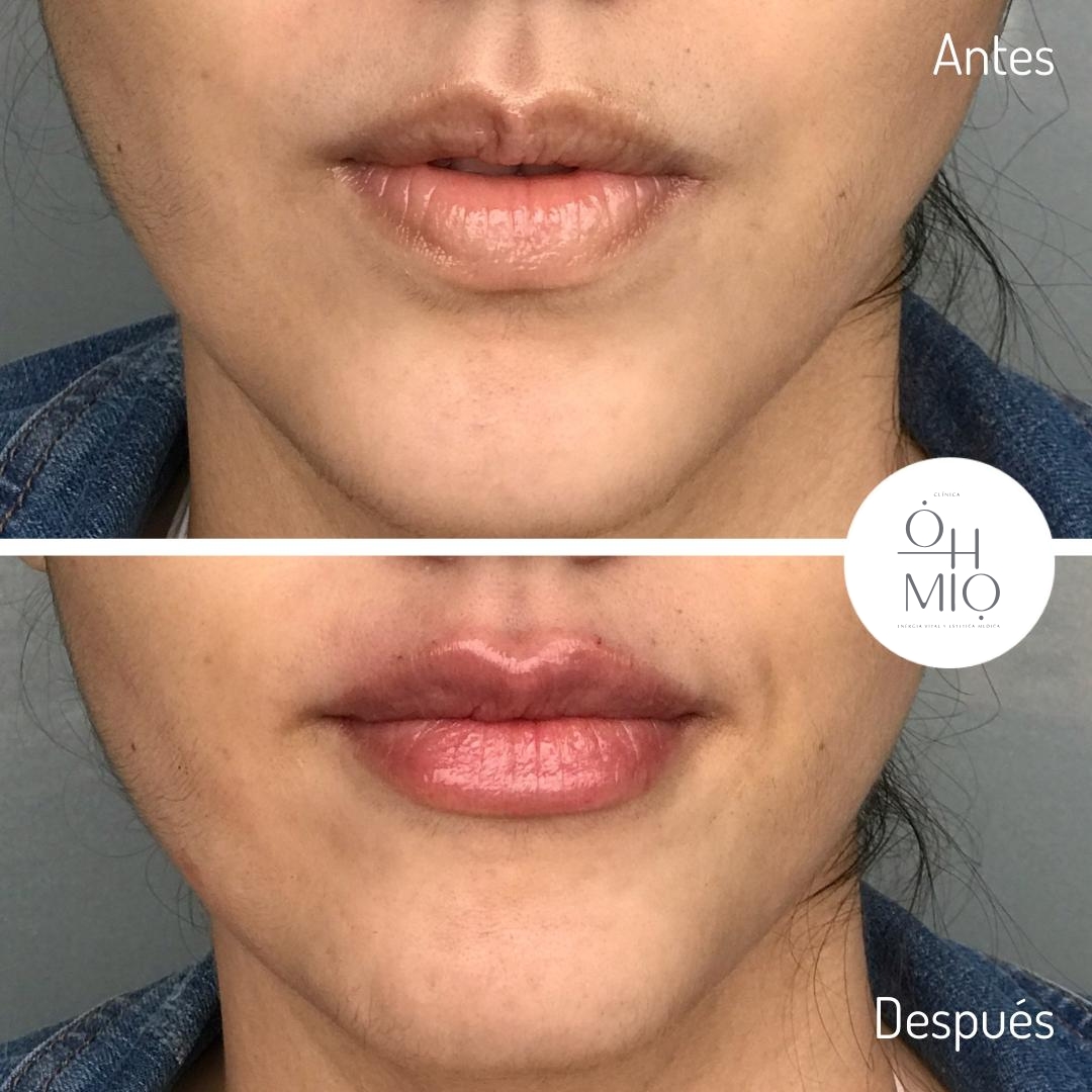Antes y después de diseño de labios con ácido hialurónico, caso 3