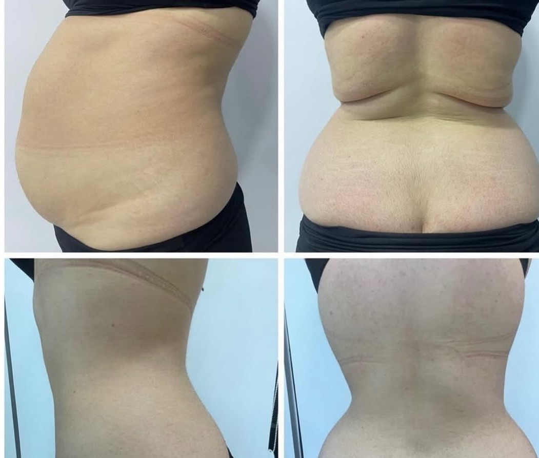 G9 Body Contouring & Cellulite — Before & After 7