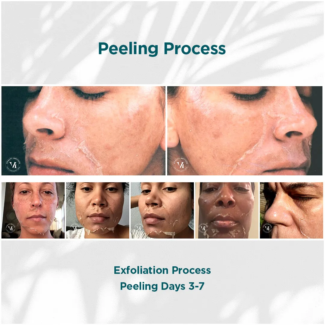 Hyperpigmentation, PIH & Acne Scars — VI Peel Advanced + Precision Plus, 3 Series