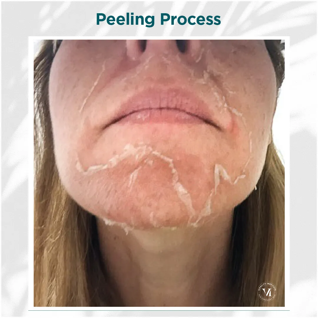 Peeling Process — Lower Face, Days 3–7