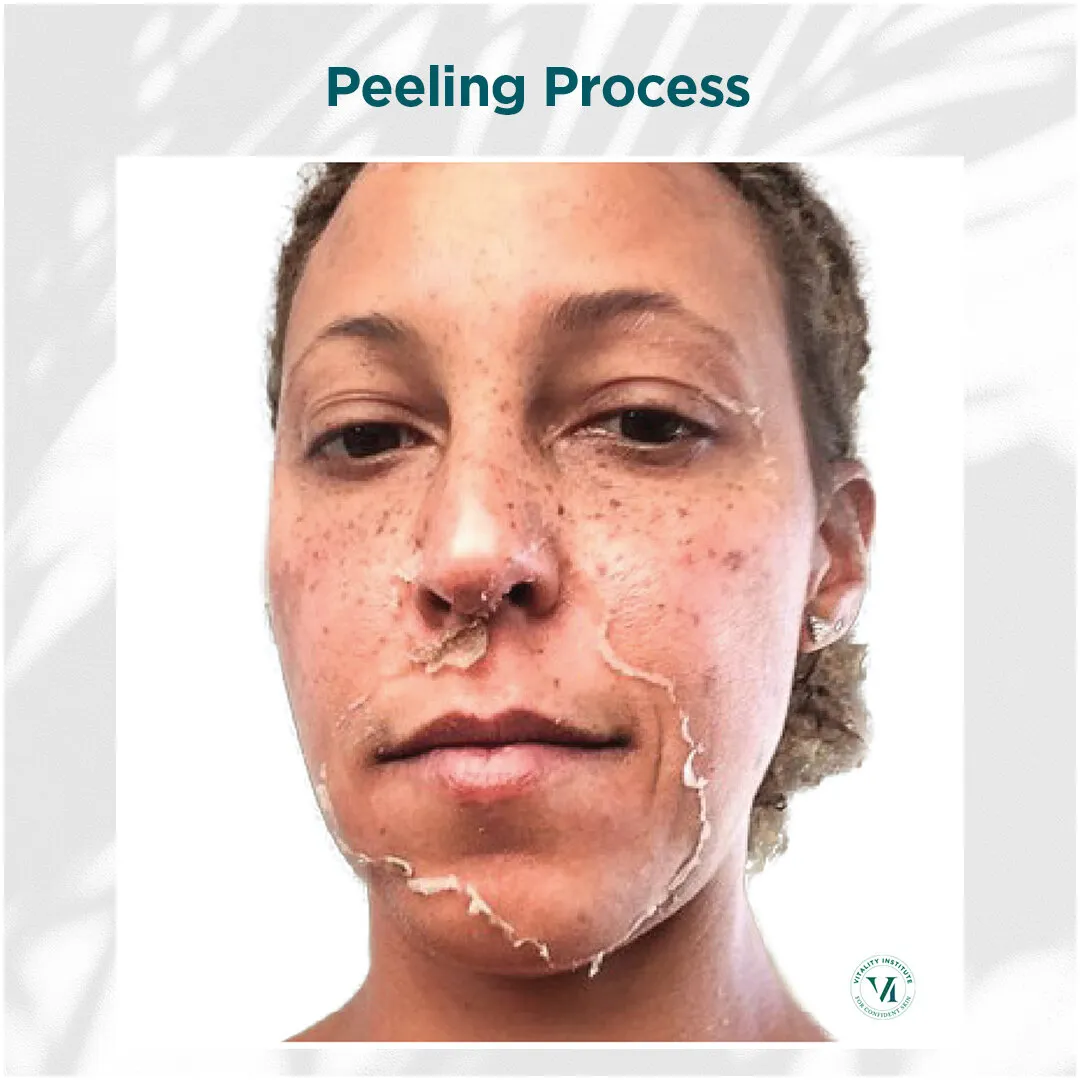 Peeling Process — Medium Skin Tone, Days 3–7