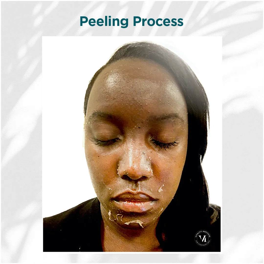 Peeling Process — Deep Skin Tone, Days 3–7