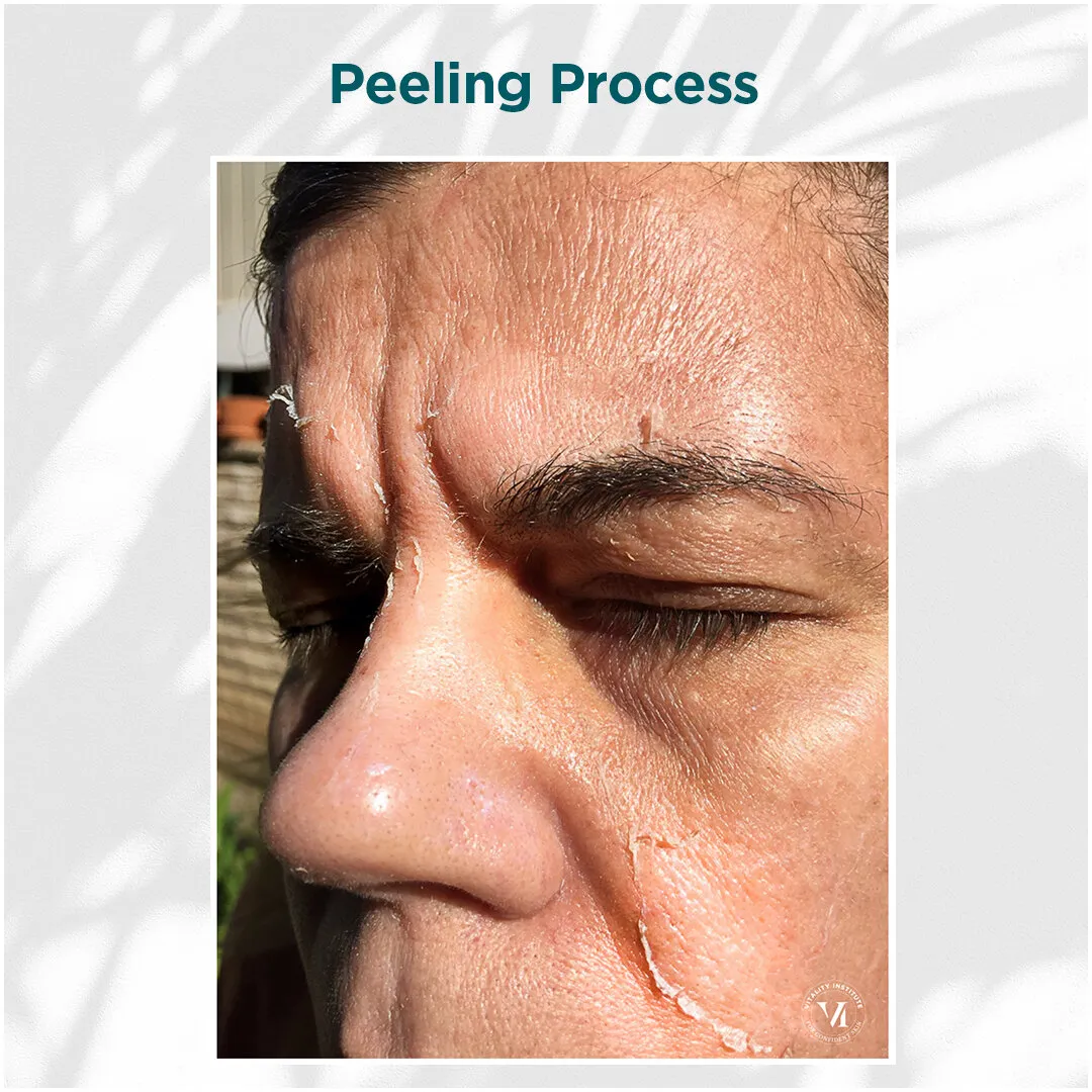 Peeling Process — Male Client, Forehead & Eye Area, Days 3–7
