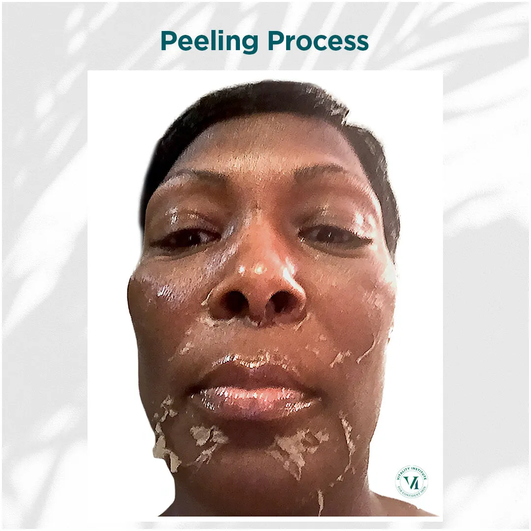 Peeling Process — Deep Skin Tone, Full Face, Days 3–7