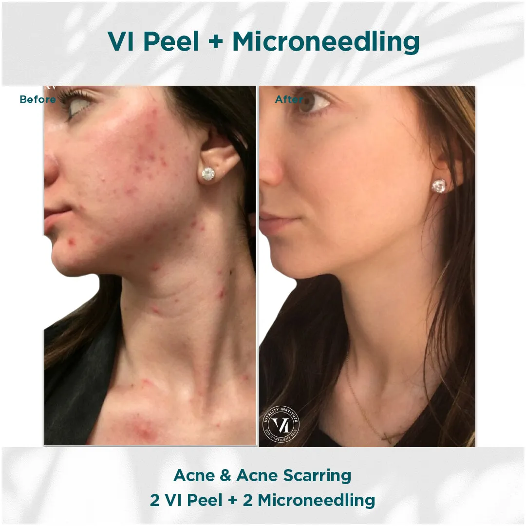 VI Peel + Microneedling — Acne & Acne Scarring