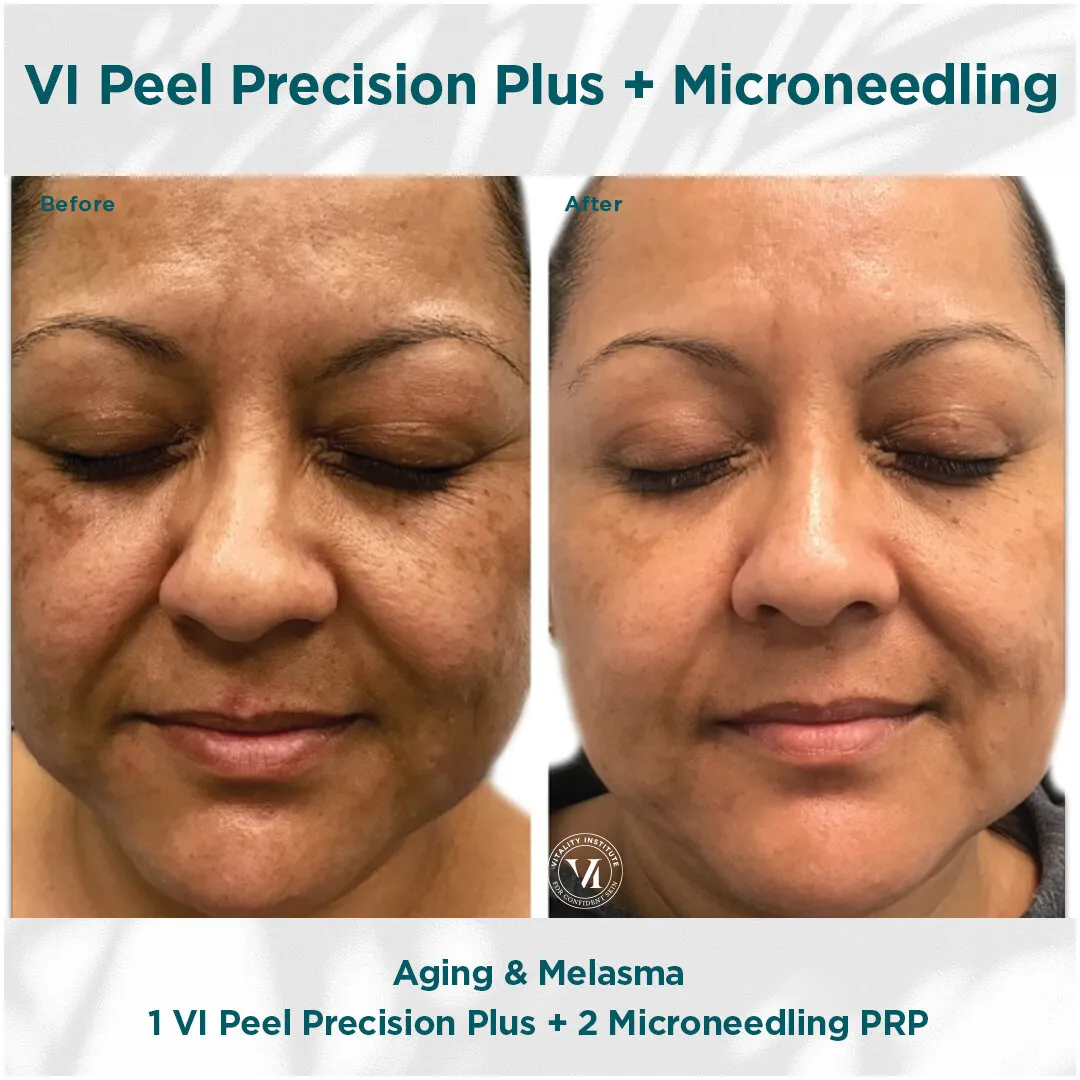 VI Peel Precision Plus + Microneedling — Aging & Melasma