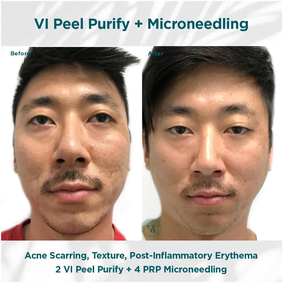 VI Peel Purify + Microneedling — Acne Scarring, Texture & Post-Inflammatory Erythema