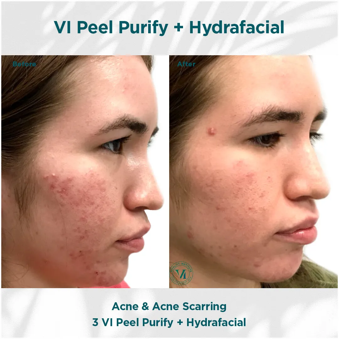 VI Peel Purify + Hydrafacial — Acne & Acne Scarring (3 Sessions)