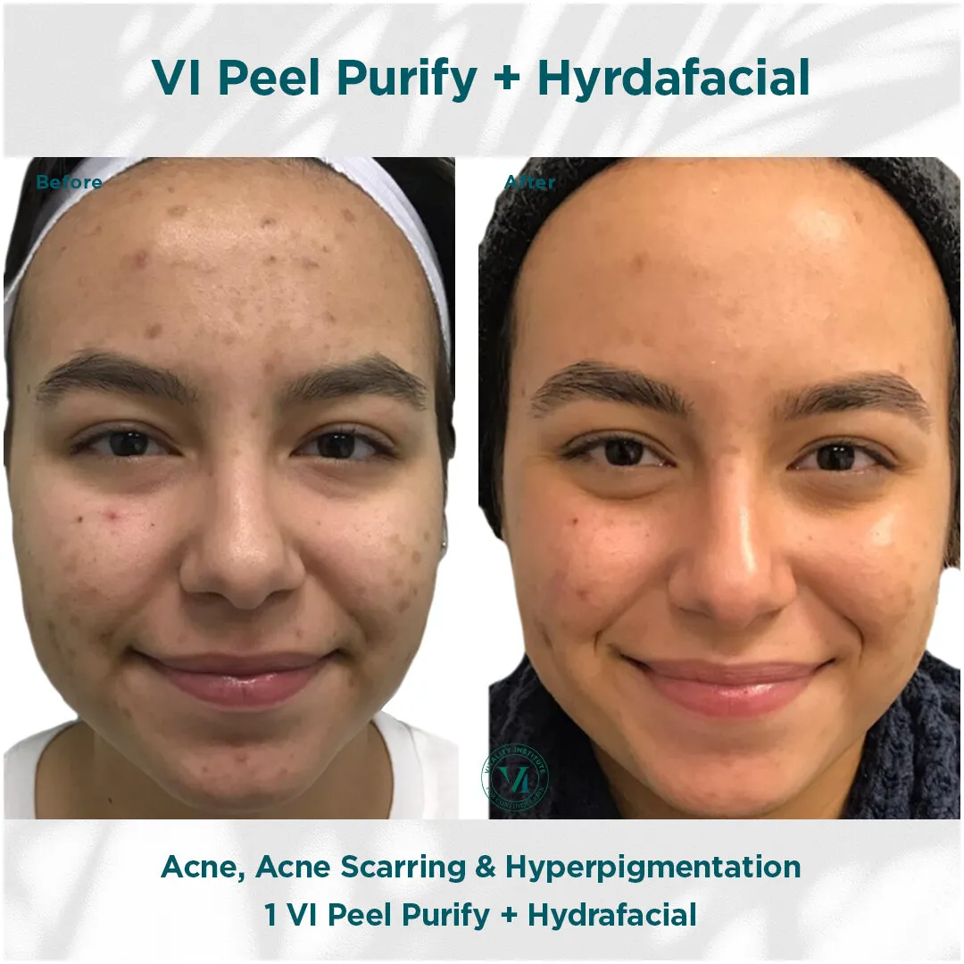 VI Peel Purify + Hydrafacial — Acne, Acne Scarring & Hyperpigmentation
