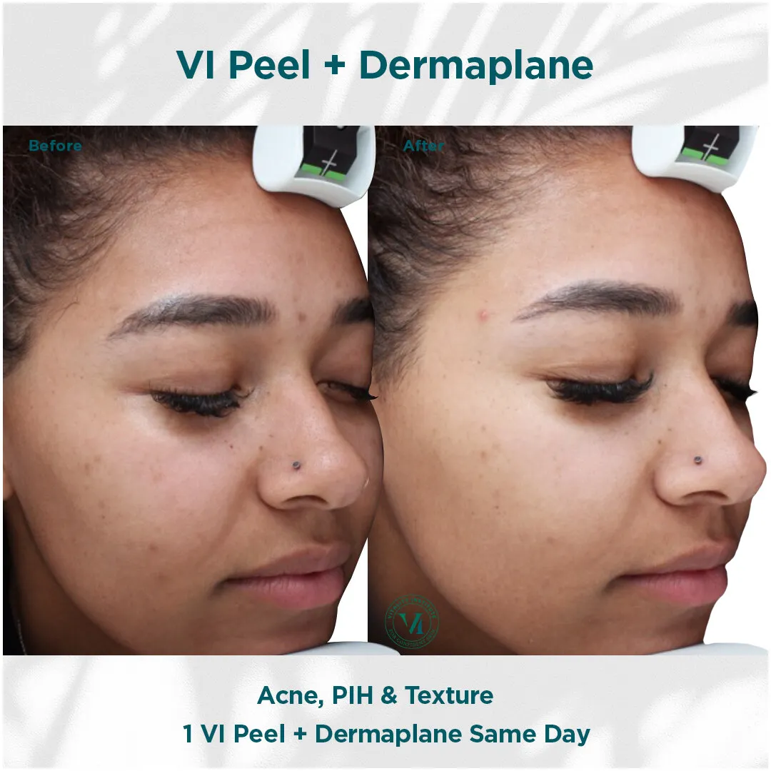VI Peel + Dermaplane — Acne, PIH & Texture