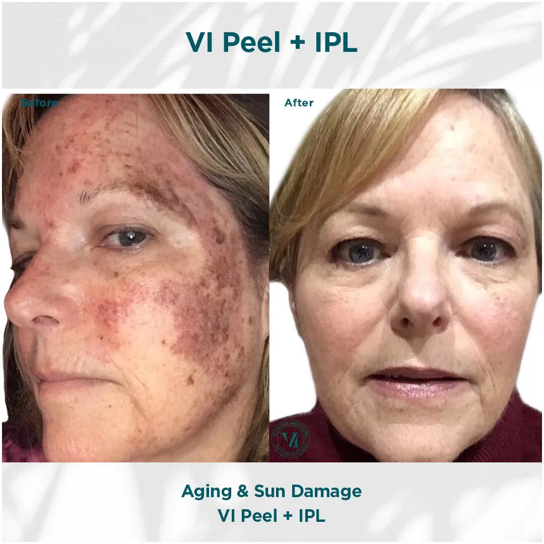 VI Peel + IPL — Aging & Sun Damage