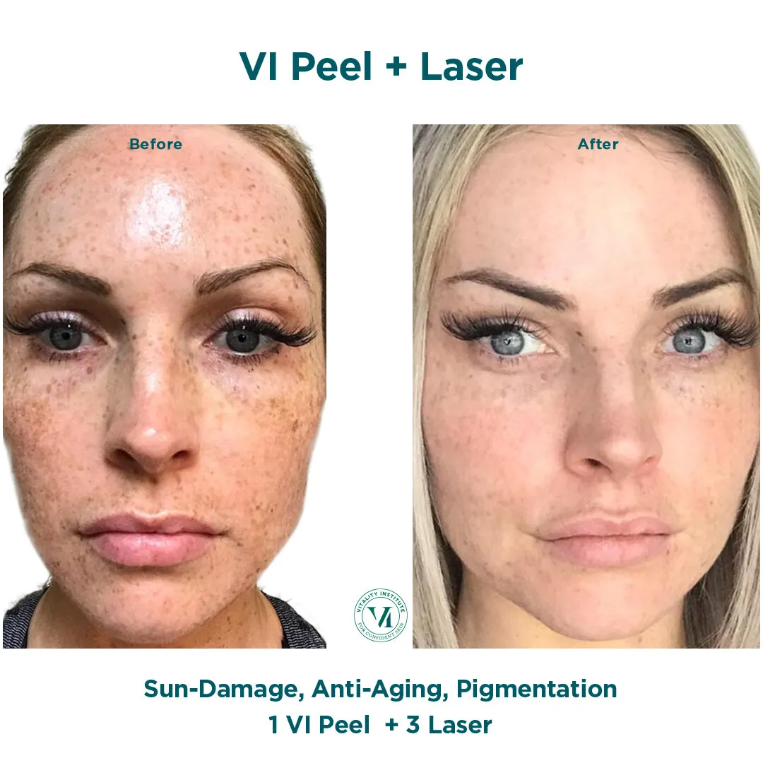 VI Peel + Laser — Sun Damage, Anti-Aging & Pigmentation
