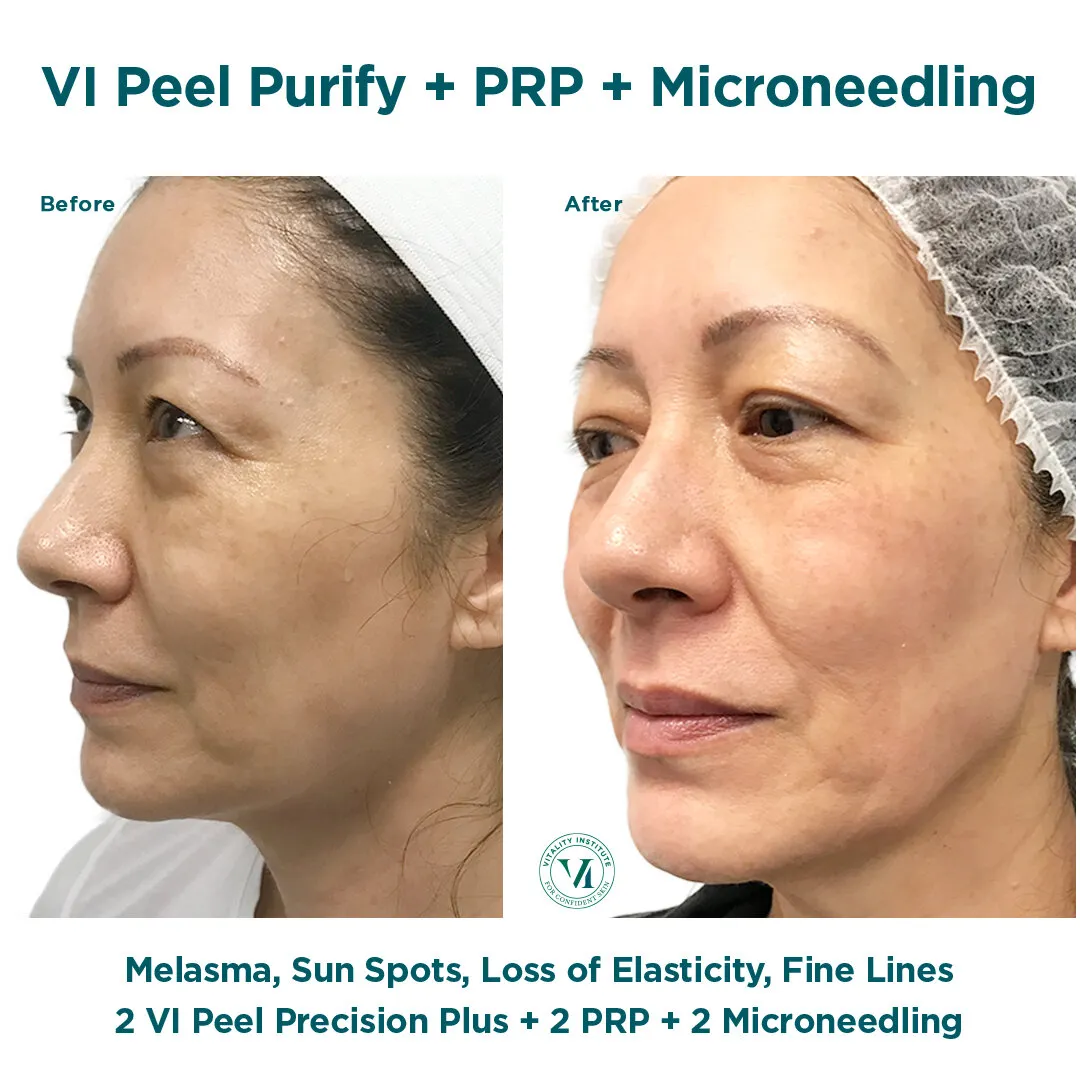 VI Peel Purify + PRP + Microneedling — Melasma, Sun Spots & Loss of Elasticity