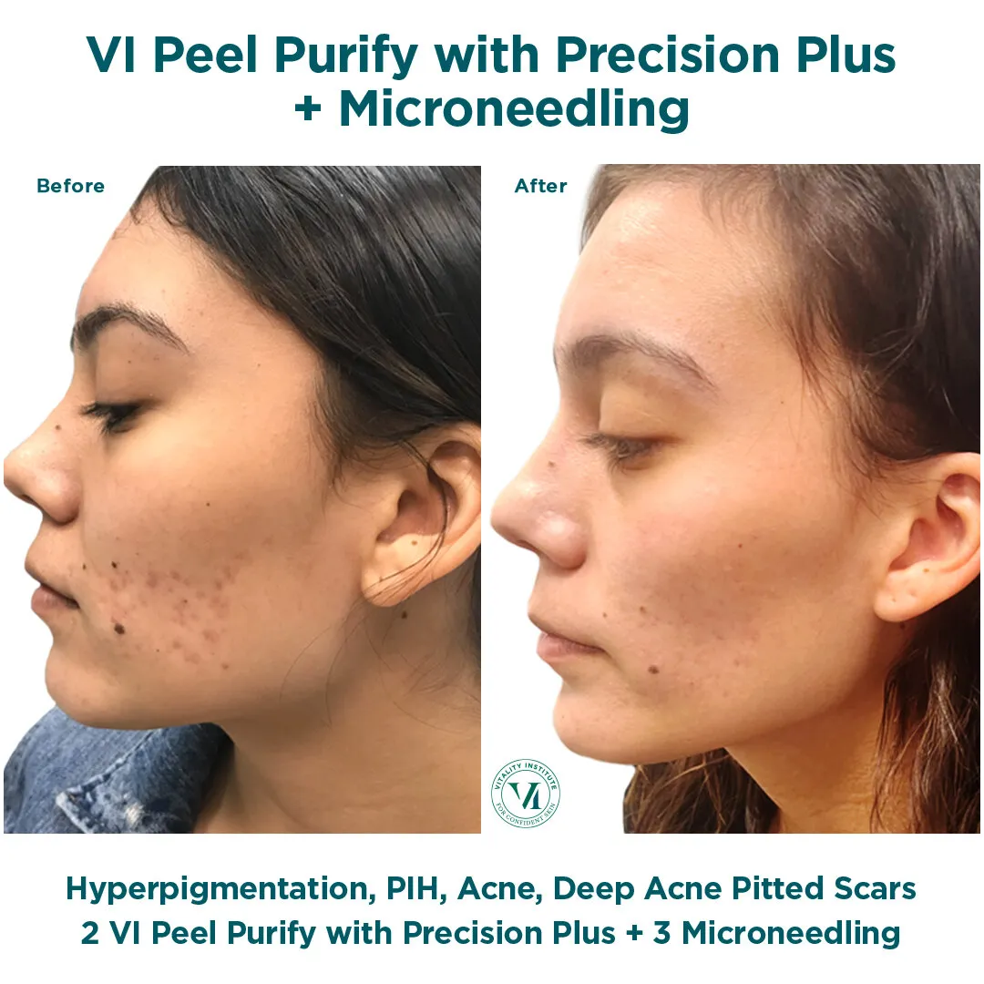 VI Peel Purify with Precision Plus + Microneedling — Hyperpigmentation, PIH & Deep Acne Scars