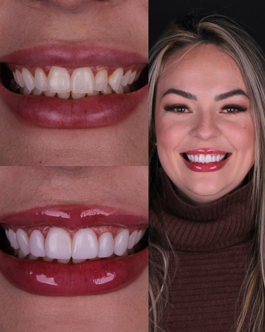 Before and after full smile transformation