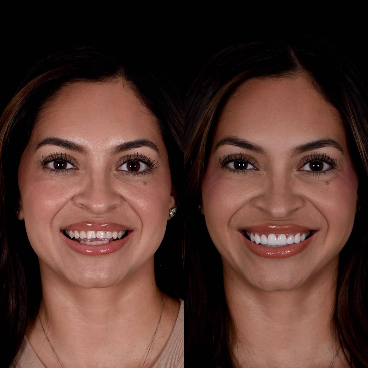 Before and after smile transformation portrait