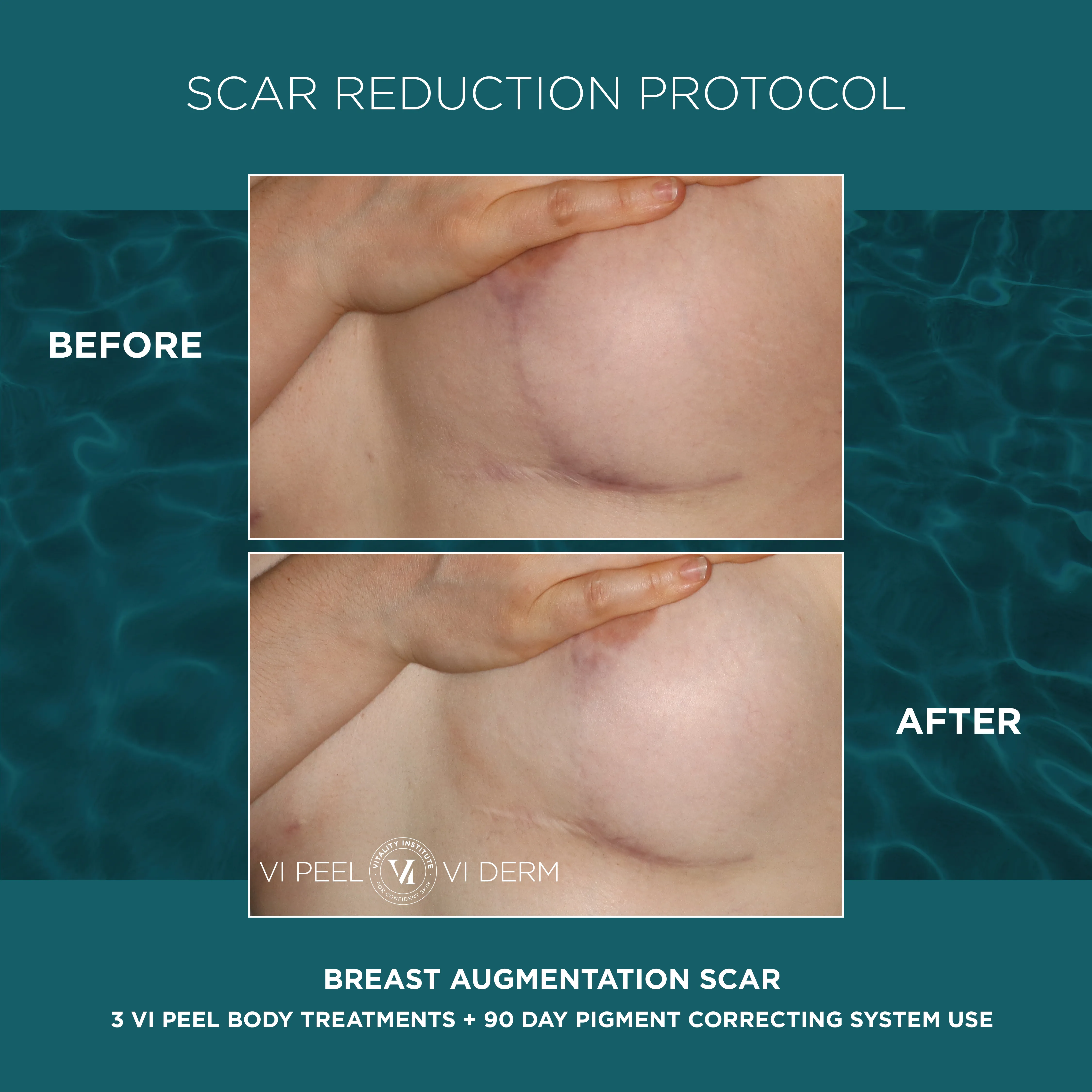 Breast Augmentation Scar — 3 VI Peel Body + 90 Day Pigment Correcting System