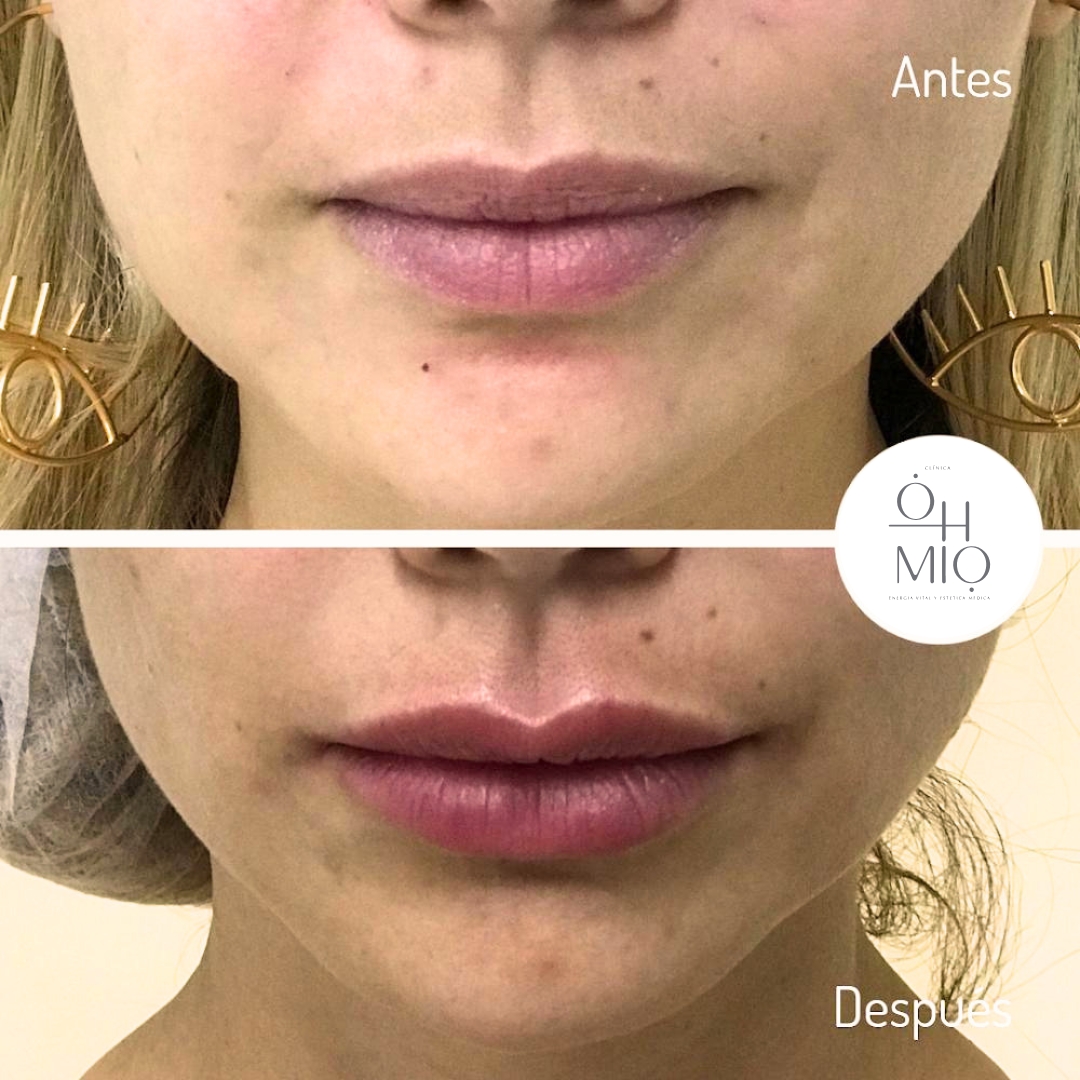 Antes y después de diseño de labios con ácido hialurónico, caso 1