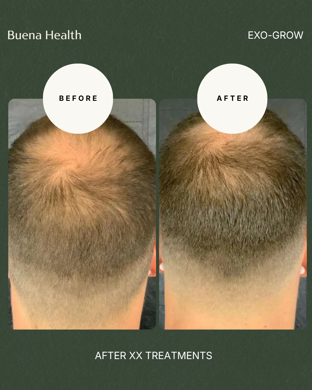 ExO-Grow scalp treatment before and after result showing fuller hair coverage