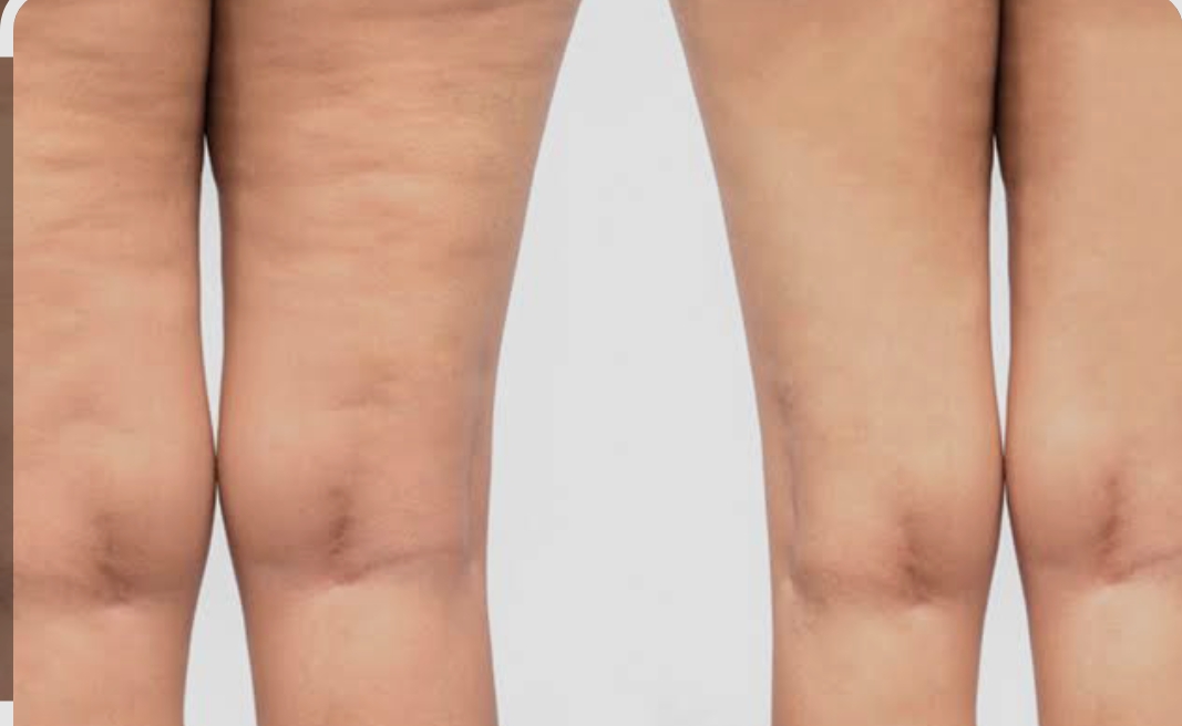 G9 Body Contouring & Cellulite — Before & After 5