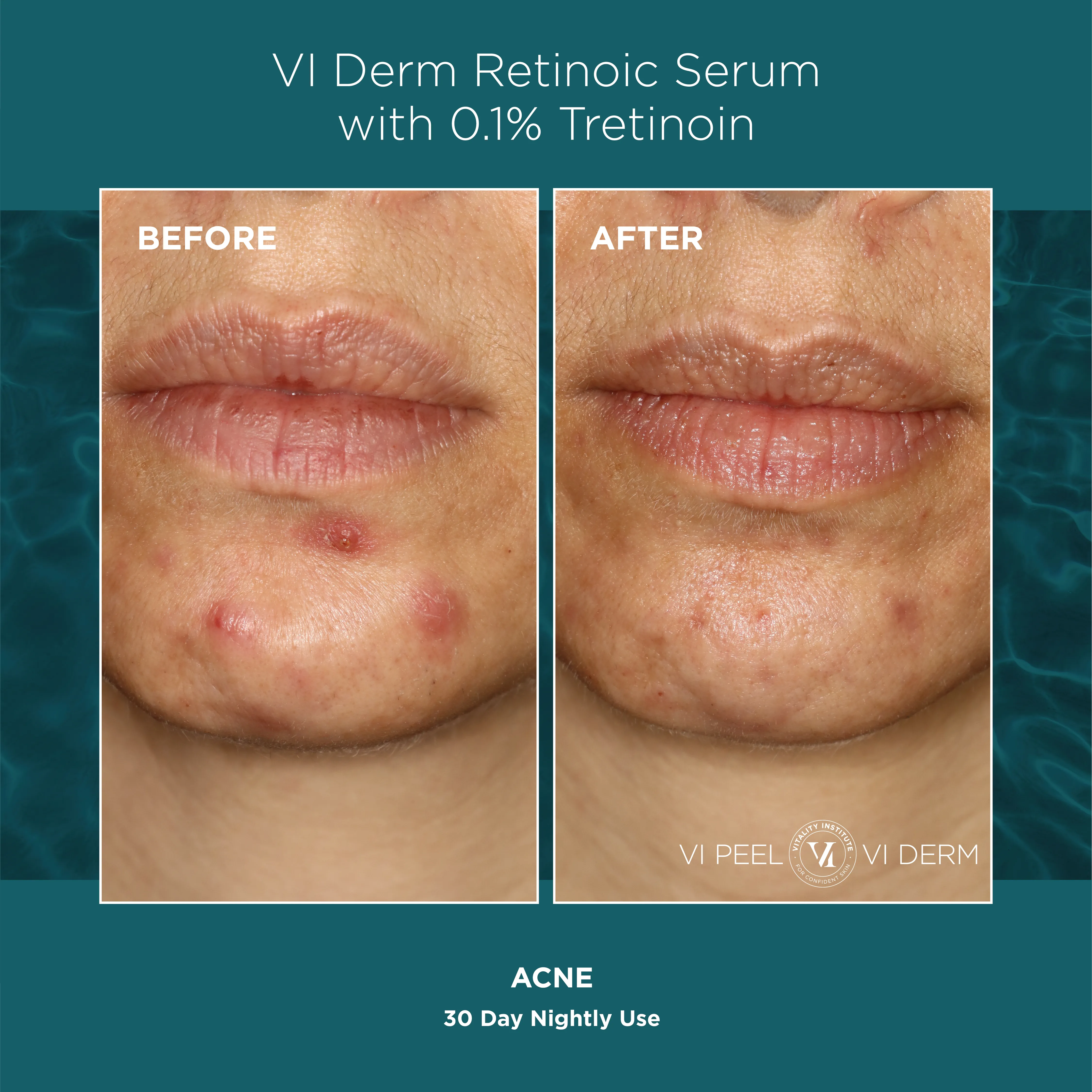 Acne — VI Derm Retinoic Serum 0.1% Tretinoin, 30 Days