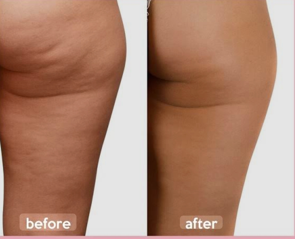 G9 Body Contouring & Cellulite — Before & After 4