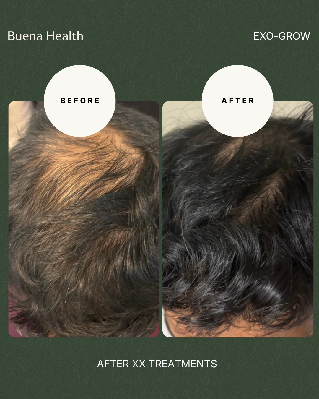 ExO-Grow scalp treatment before and after result showing improved hairline coverage