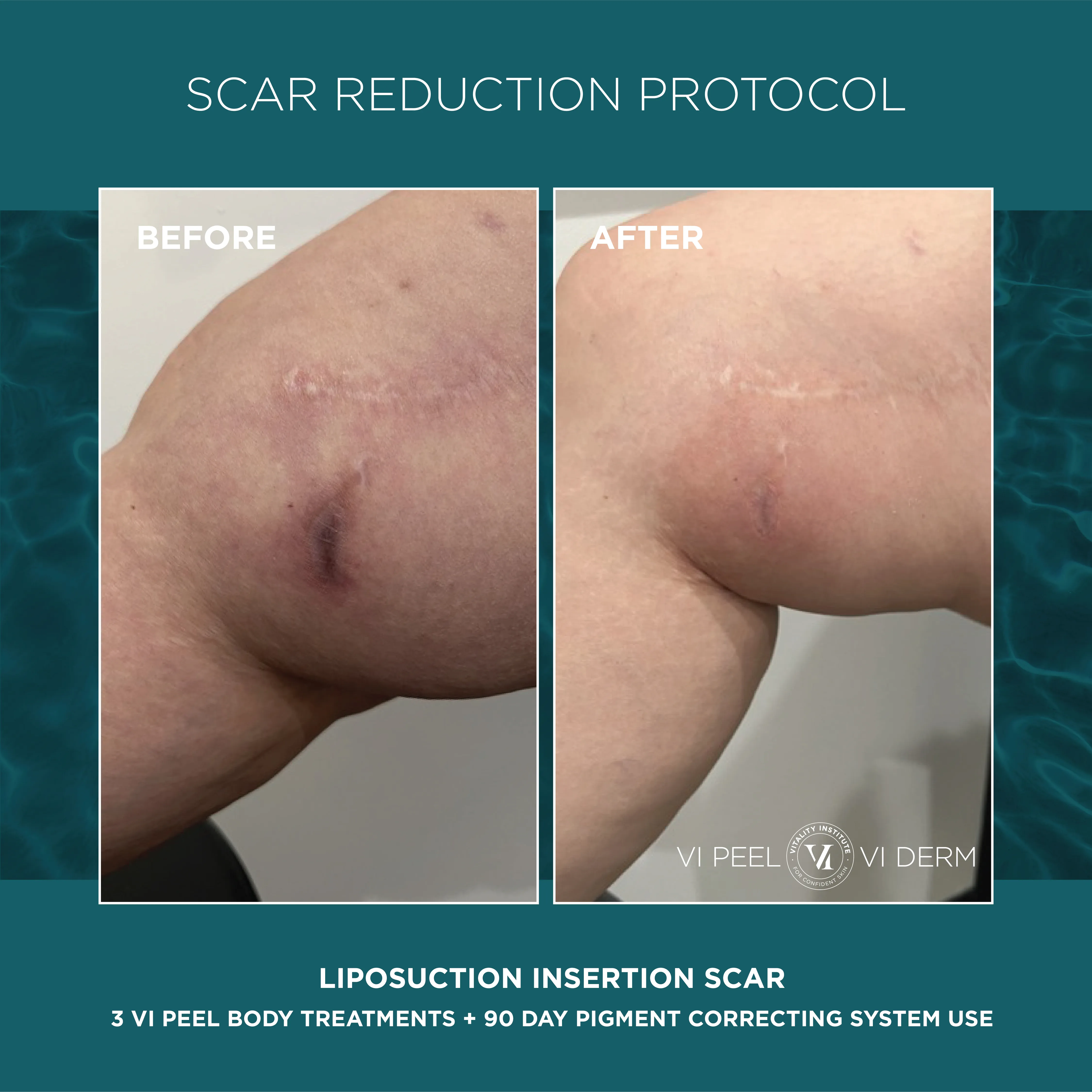 Liposuction Insertion Scar — 3 VI Peel Body + 90 Day Pigment Correcting System