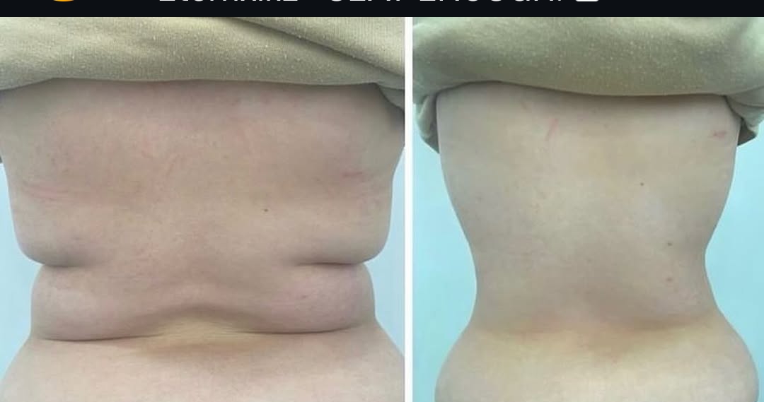 G9 Body Contouring & Cellulite — Before & After 8