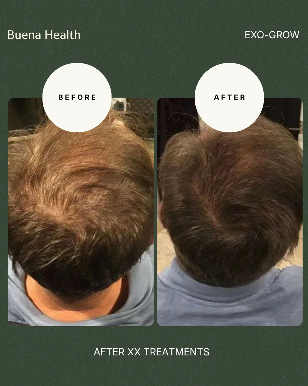 ExO-Grow scalp treatment before and after result showing improved crown coverage