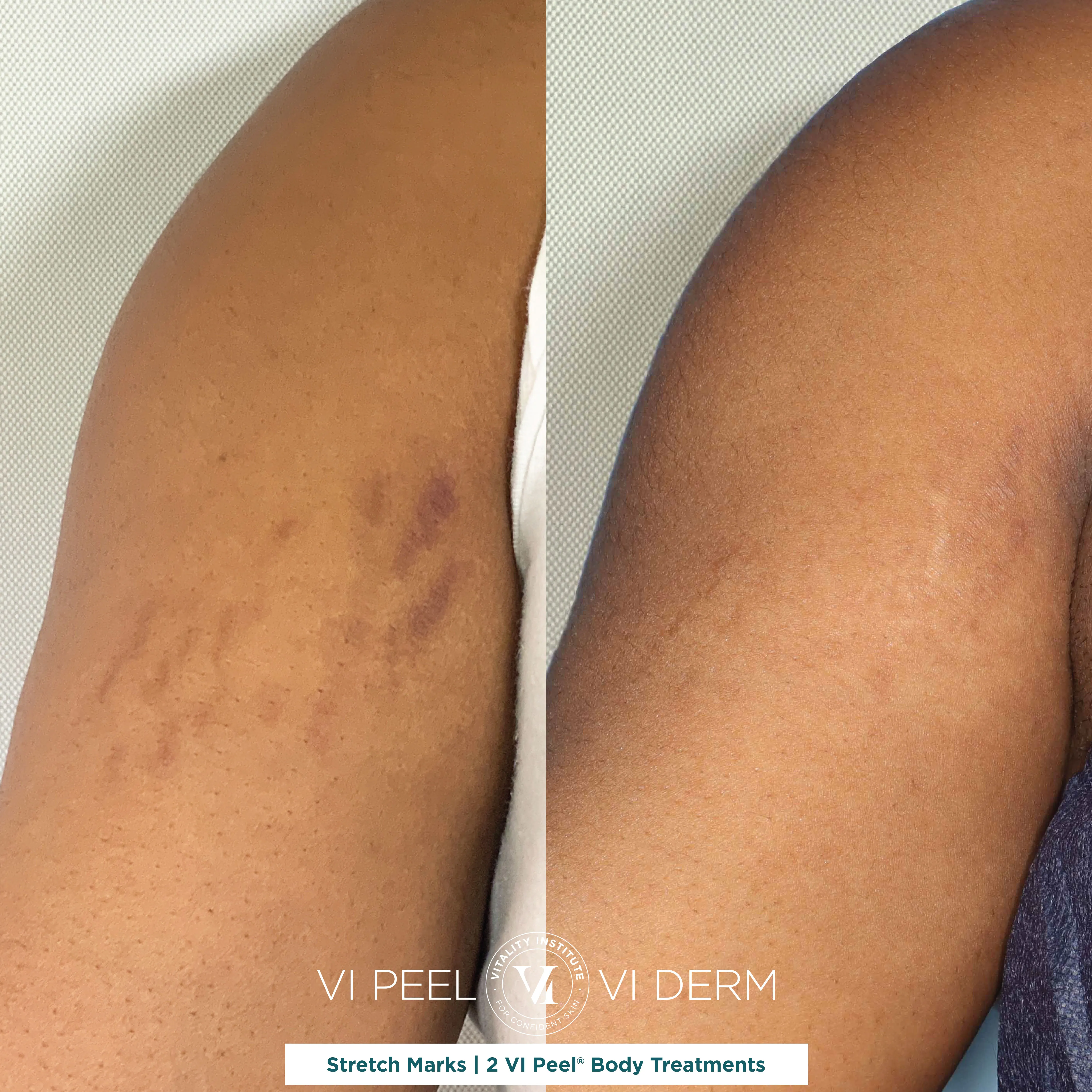 Stretch Marks — Arm, 2 VI Peel Body Treatments