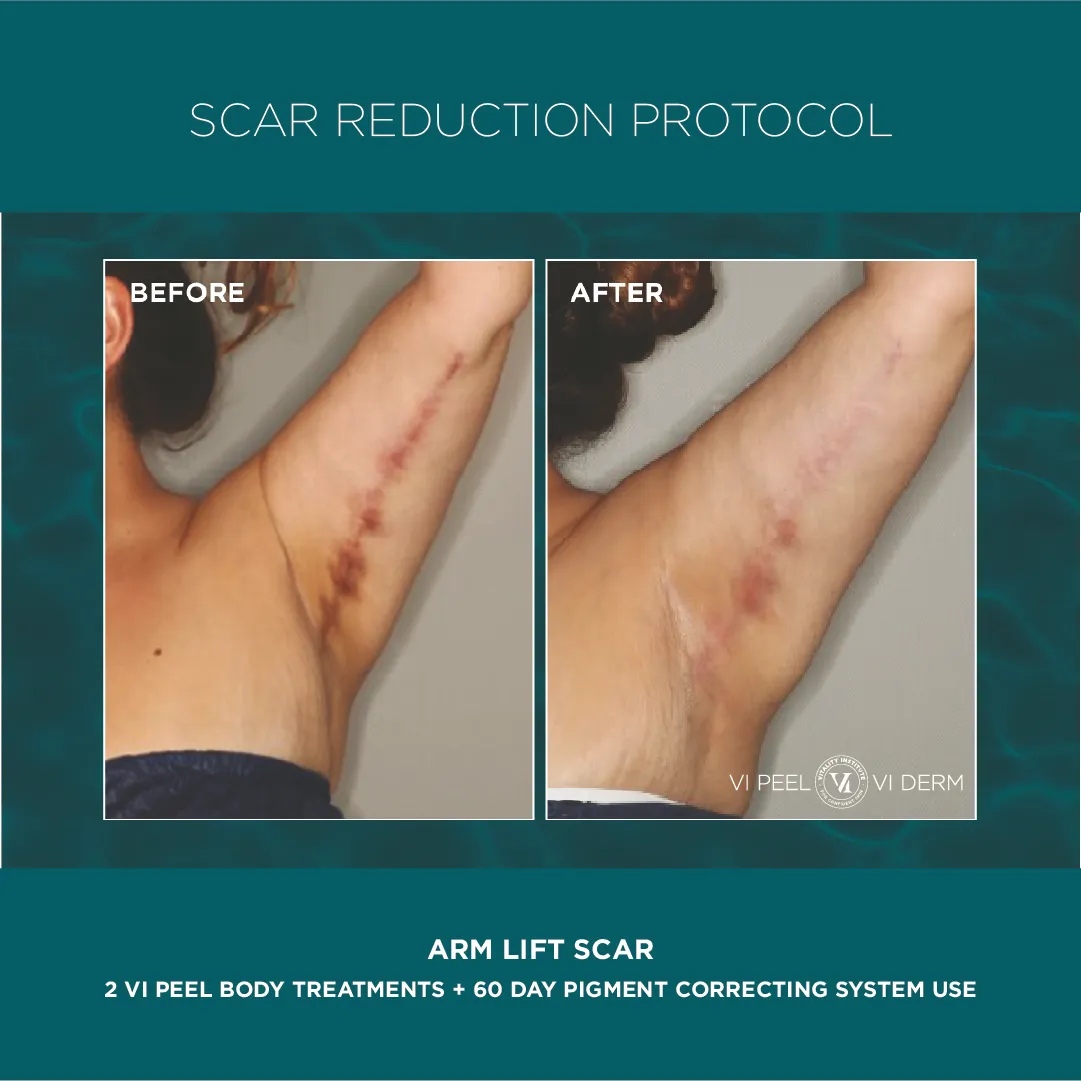 Arm Lift Surgical Scar — 2 VI Peel Body + 60 Day Pigment Correcting System