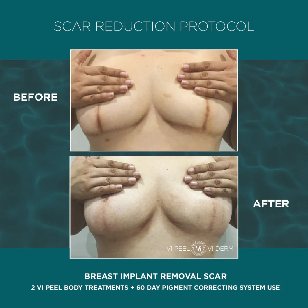 Breast Implant Removal Scar — 2 VI Peel Body + 60 Day Pigment Correcting System
