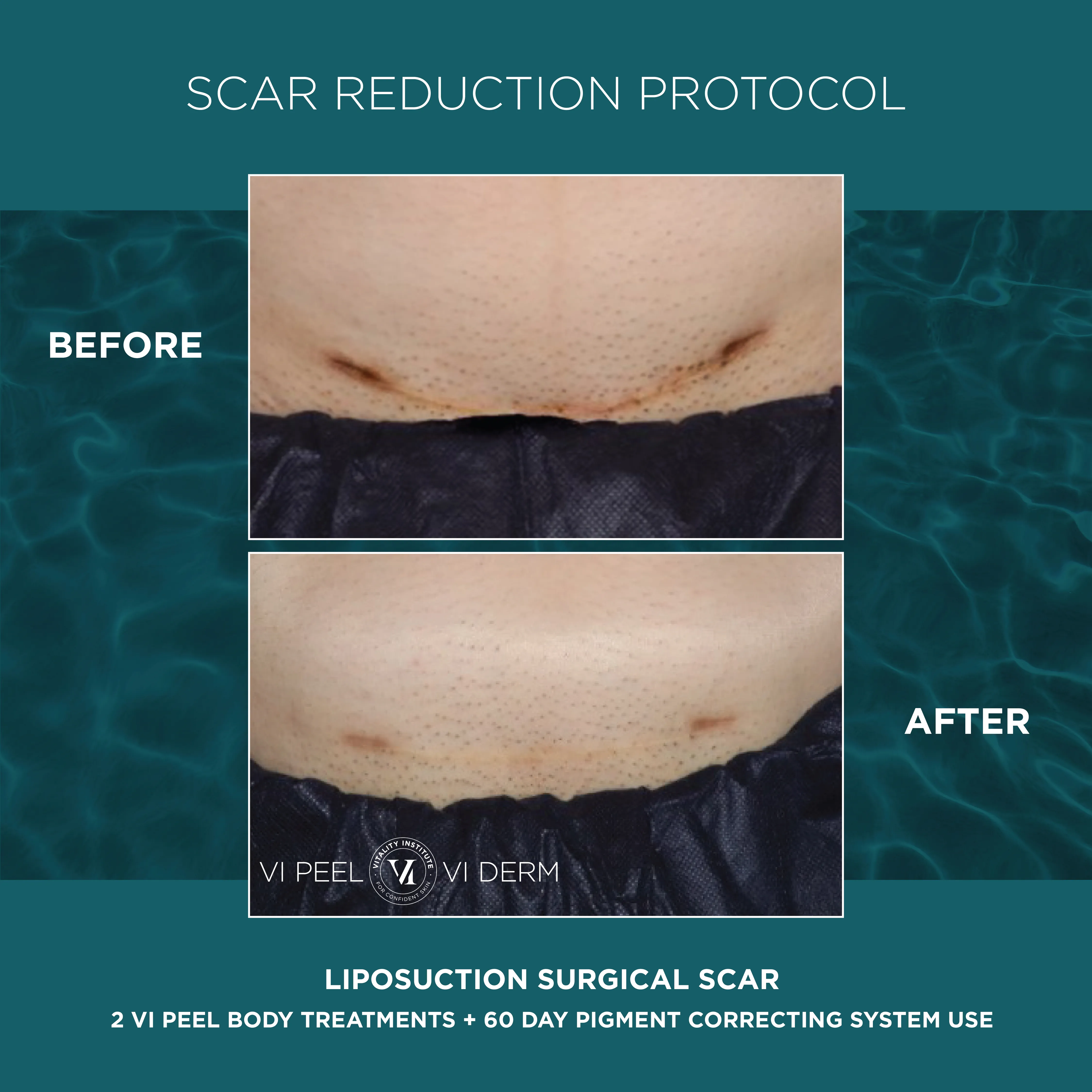 Liposuction Surgical Scar — 2 VI Peel Body + 60 Day Pigment Correcting System