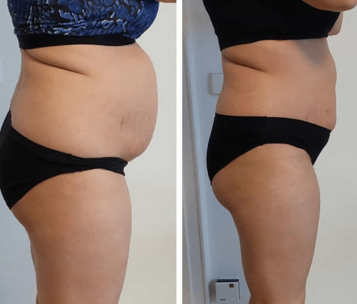 Vorher-Nachher: Bauch – Seitenprofil