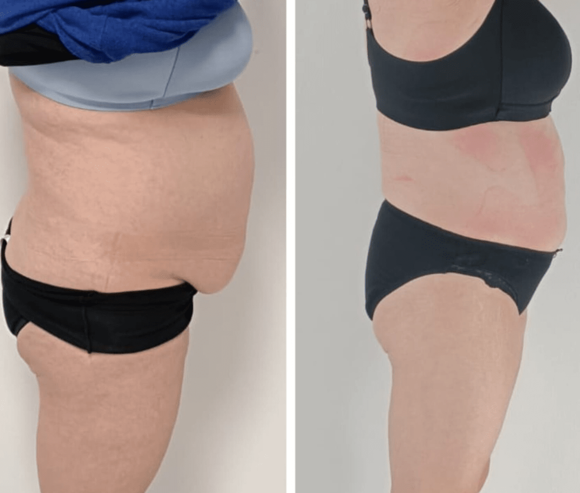 Vorher-Nachher: Bauch & Taille – Seitenprofil