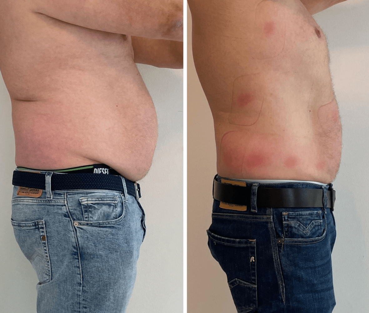 Vorher-Nachher: Bauch – Seitenprofil