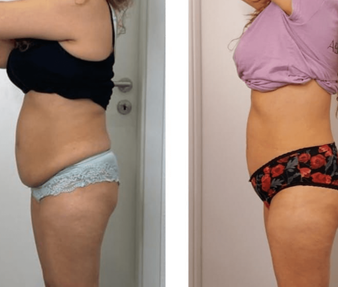 Vorher-Nachher: Bauch & Taille