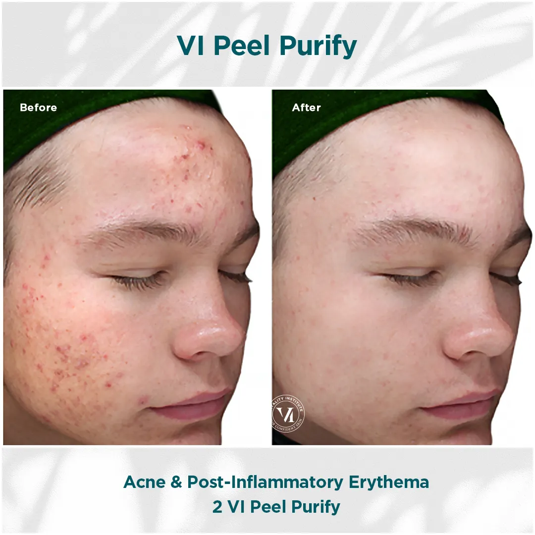 Acne & Post-Inflammatory Erythema — 2 VI Peel Purify