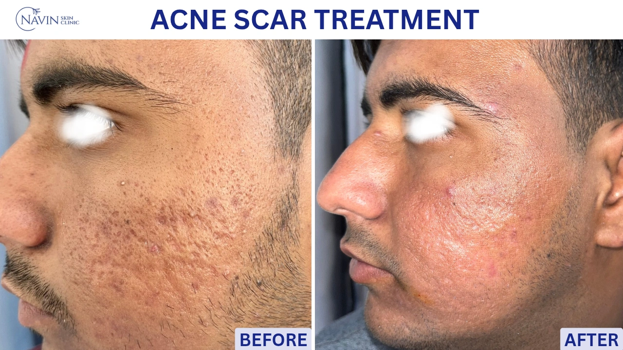 Acne Scar Treatment - Before